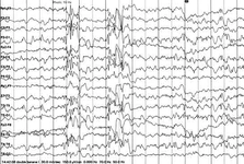 Miyoklonik Epilepsi Belirtileri ve Tedavisi Miyoklonik Epilepsi Belirtileri ve Tedavisi