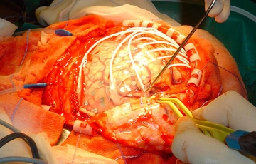 Epilepsi Ameliyatı Nasıl Yapılır? Epilepsi Ameliyatı Nasıl Yapılır?